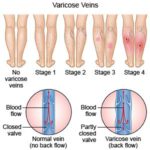 Compression Stockings Venous Insufficiency